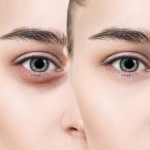 3 Beauty Tips to Get Rid of Dark Circles Under Eyes