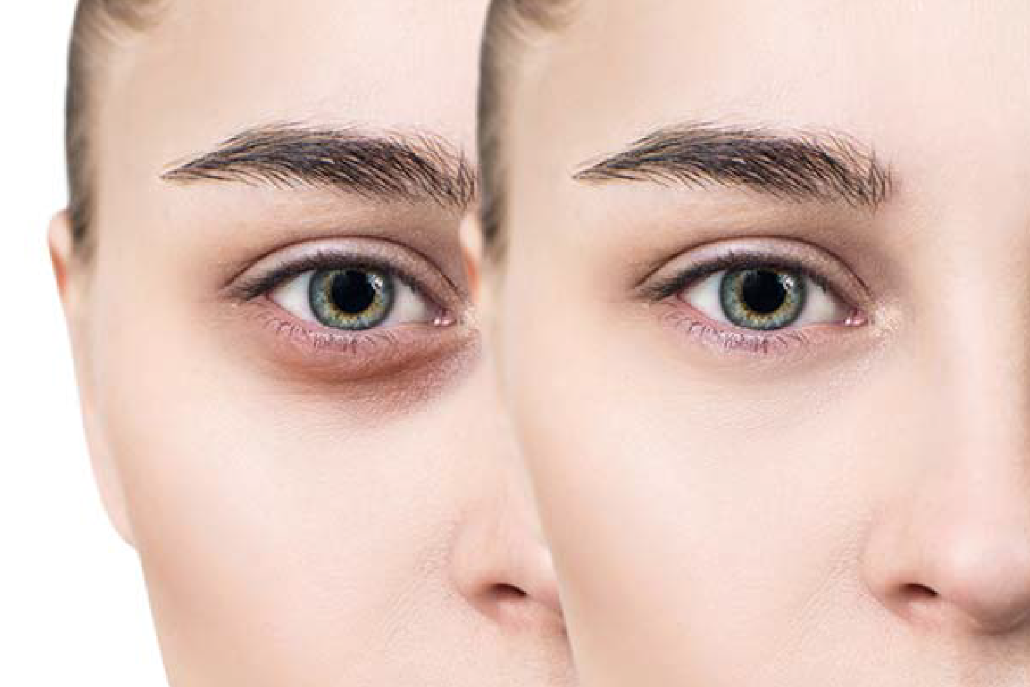 3 Beauty Tips to Get Rid of Dark Circles Under Eyes