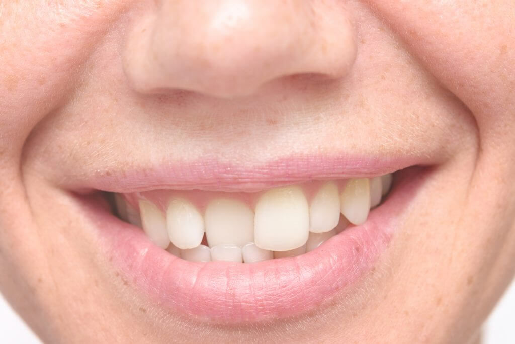 Causes and Treatment of Crooked Teeth