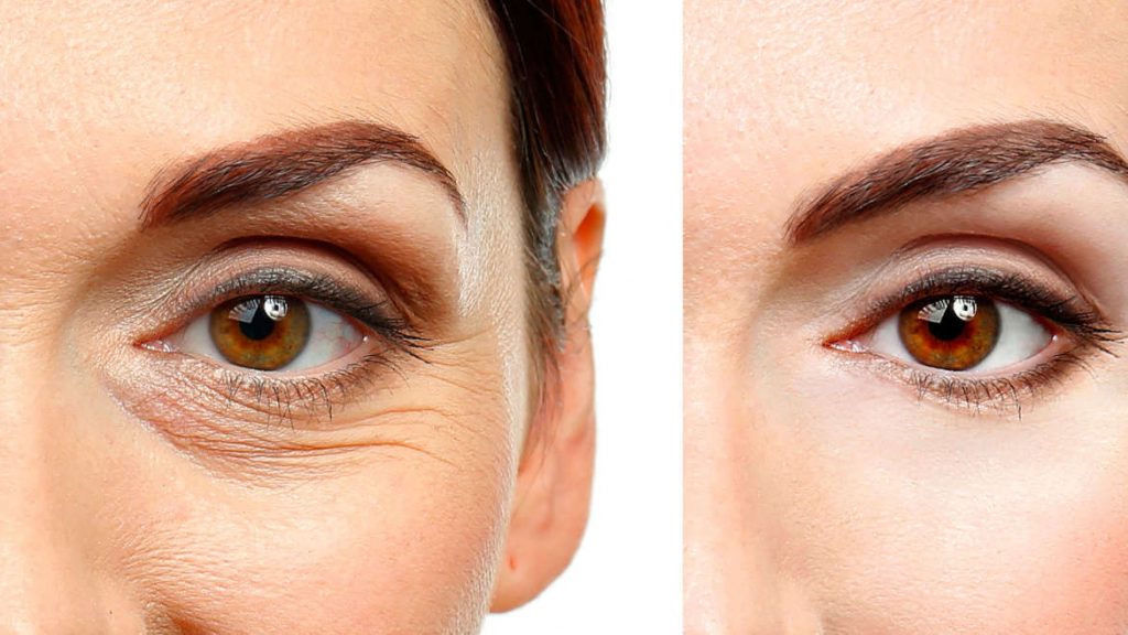 What Is Blepharoplasty And What Are Its Benefits? Health Fitness