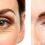 What is Blepharoplasty and What Are its Benefits?